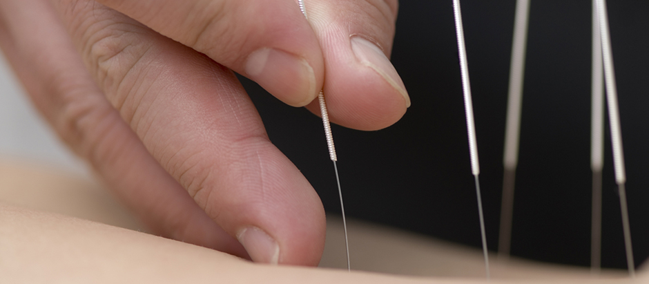 acupuncture needles